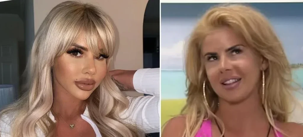 hannah love island before and after surgery 1