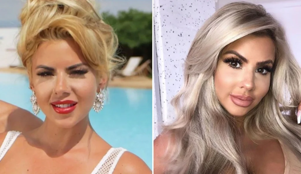 Hannah Love Island Before and After
